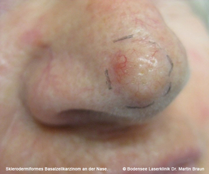 Basaliome durch zuviel UVStrahlung Bodensee Laserklinik Dr. Martin Braun Hautarzt Überlingen