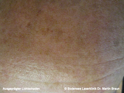 Age Spots Bodensee Laserklinik Dr Martin Braun Hautarzt Uberlingen