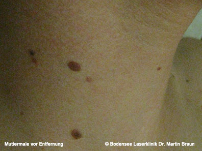 Alterswarzen Bodensee Laserklinik Dr Martin Braun Hautarzt Uberlingen