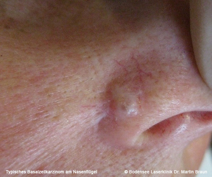 Basaliome durch zuviel UVStrahlung Bodensee Laserklinik Dr. Martin