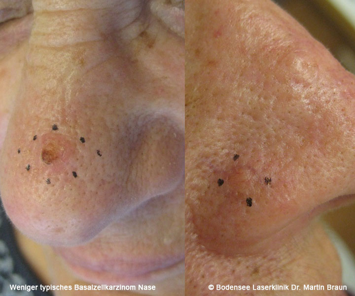 Basaliome durch zuviel UVStrahlung Bodensee Laserklinik Dr. Martin Braun Hautarzt Überlingen