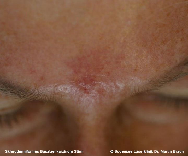 Basaliome durch zuviel UVStrahlung Bodensee Laserklinik Dr. Martin Braun Hautarzt Überlingen