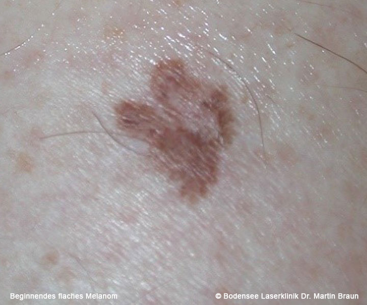 Das Maligne Melanom - Bodensee Laserklinik | Dr. Martin ...