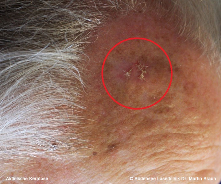Kruste Auf Der Haut Geht Nicht Weg www.klinik-braun.de